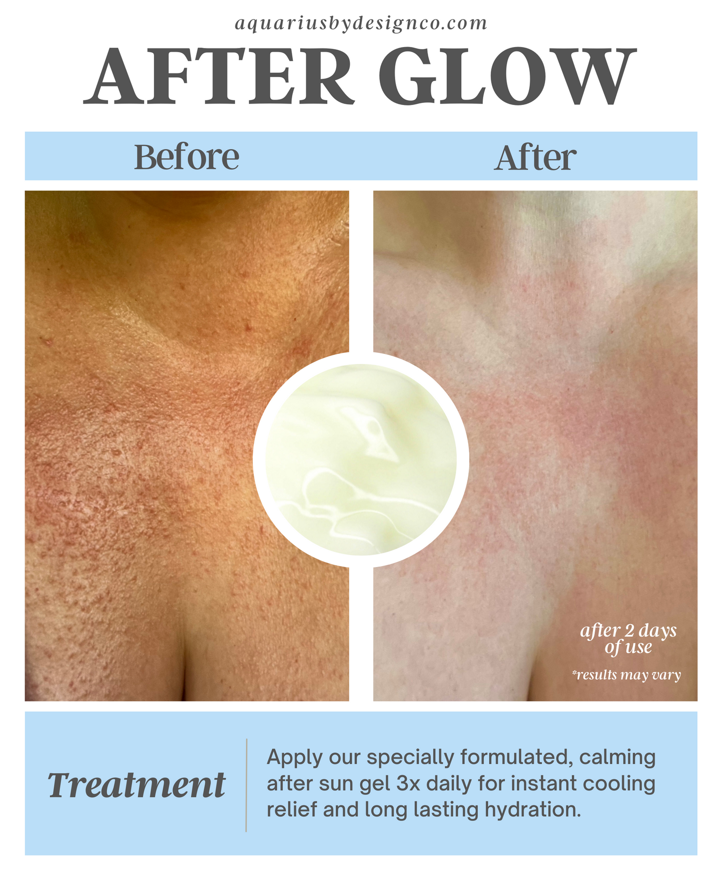 After Glow Calming After Sun Gel for Sunburns and Sun Poisoning