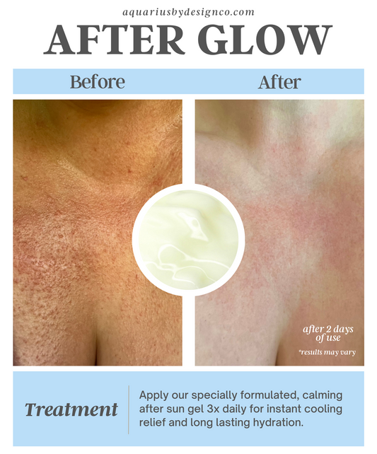 After Glow Calming After Sun Gel for Sunburns and Sun Poisoning
